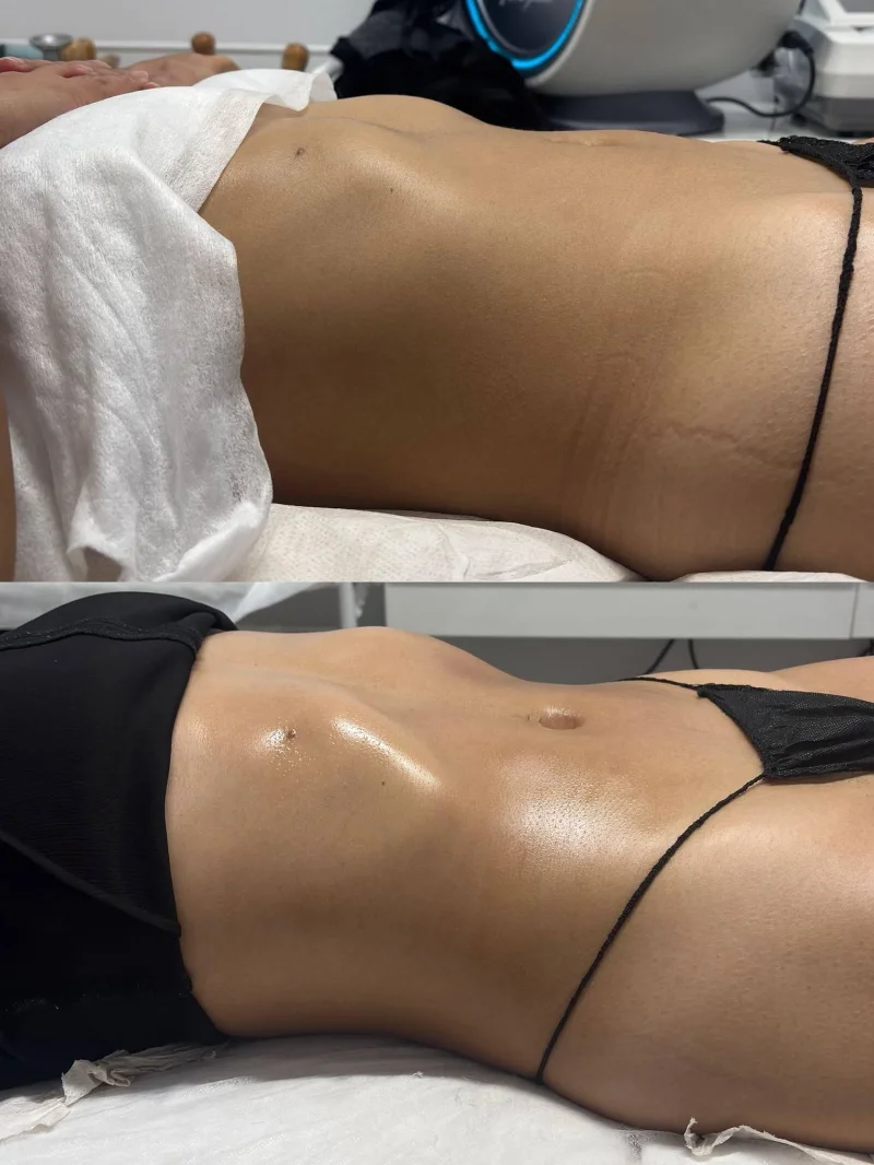 Antes y después de tratamiento corporal